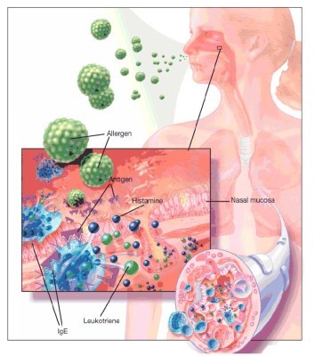 Особенности протекания и методы терапии аллергического вазомоторного ринита